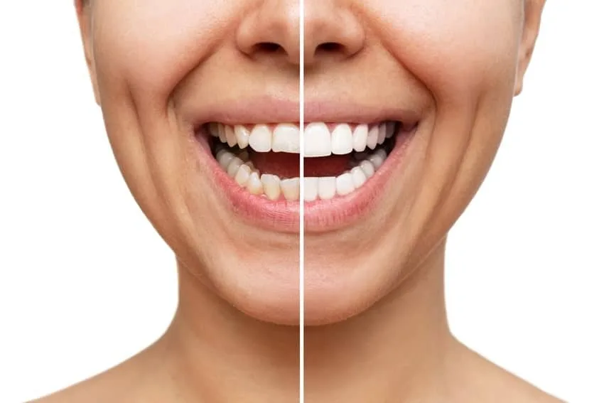Close-up comparison of a smile with and without a dental veneer