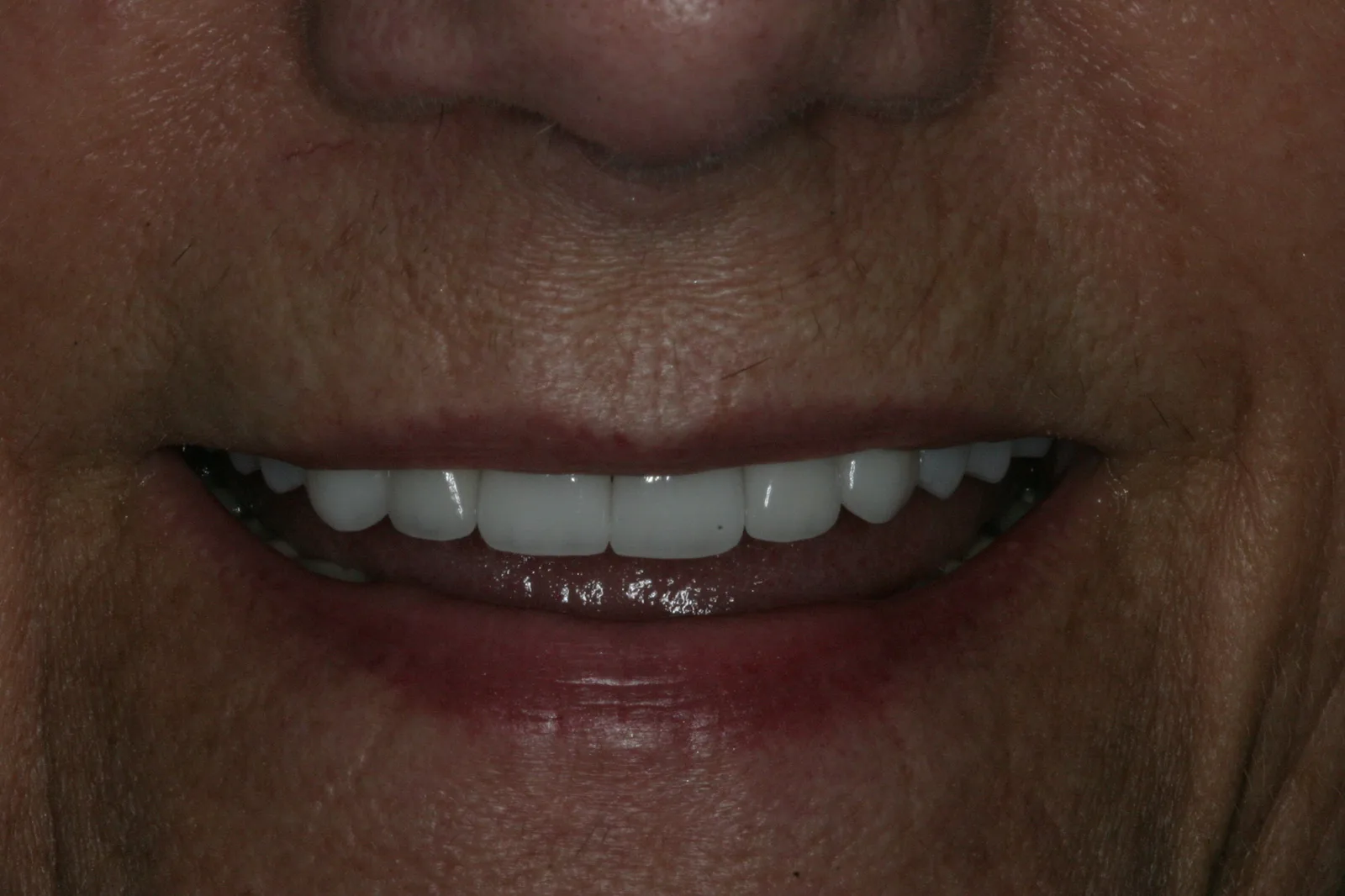 Smile gallery case 2 — after treatment