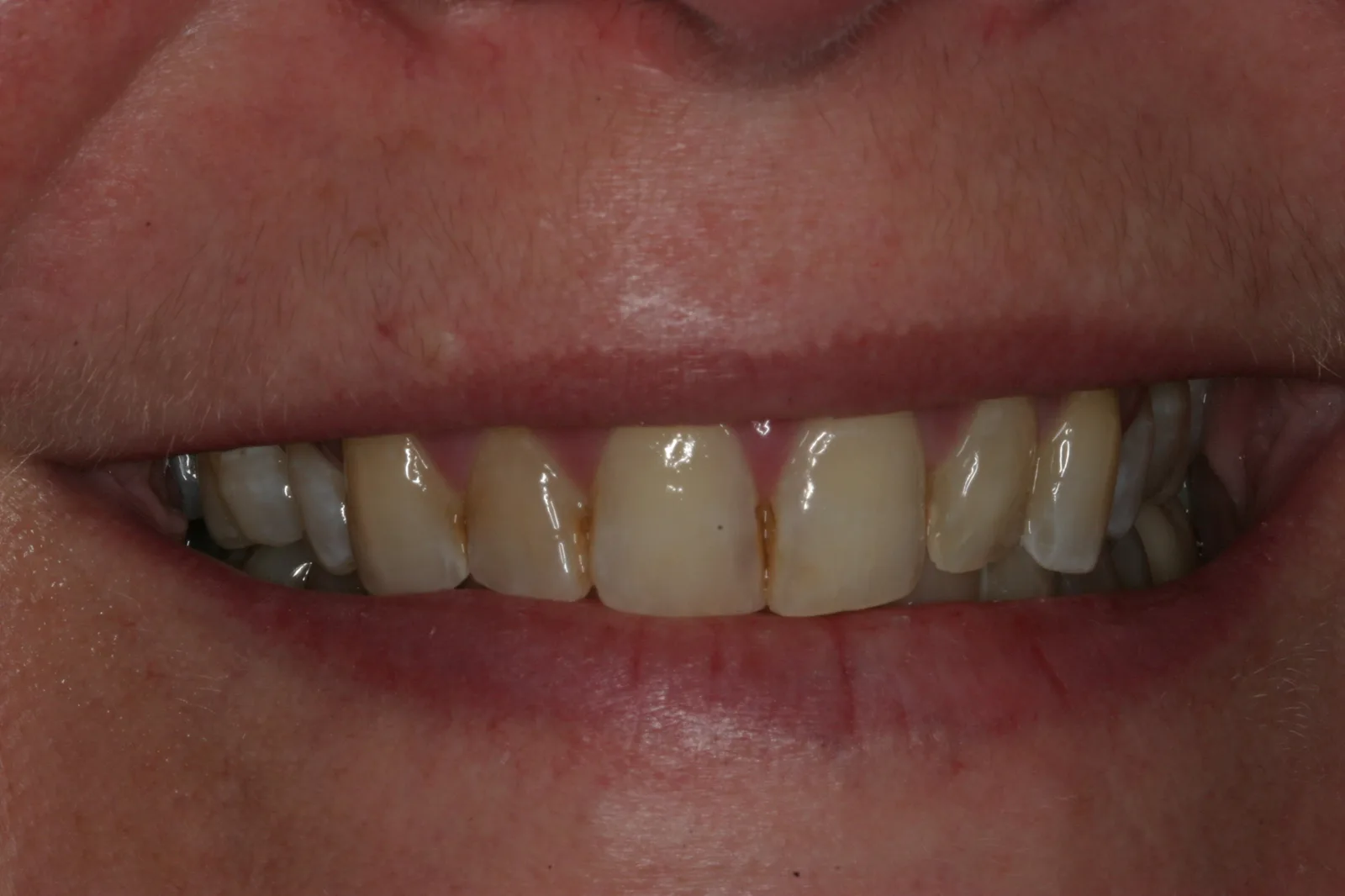 Smile gallery case 3 — before treatment
