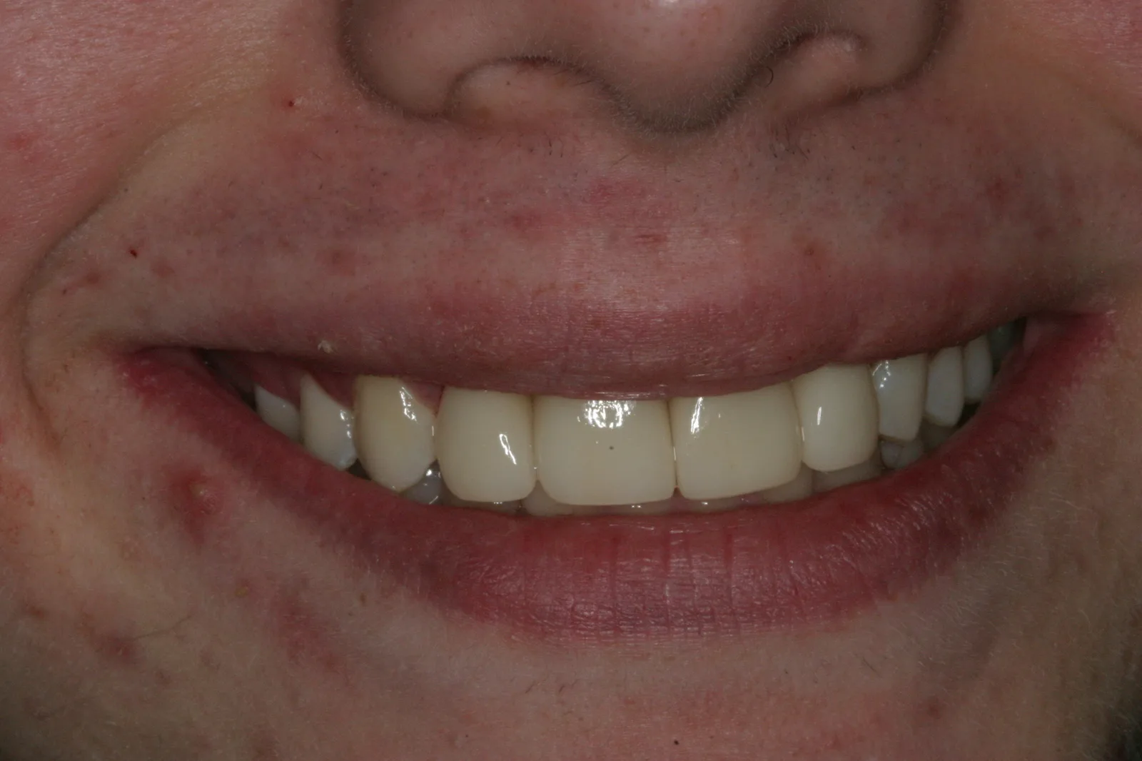 Smile gallery case 5 — after treatment