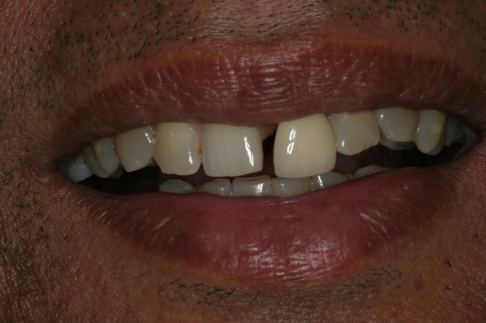 Smile gallery case 9 — before treatment
